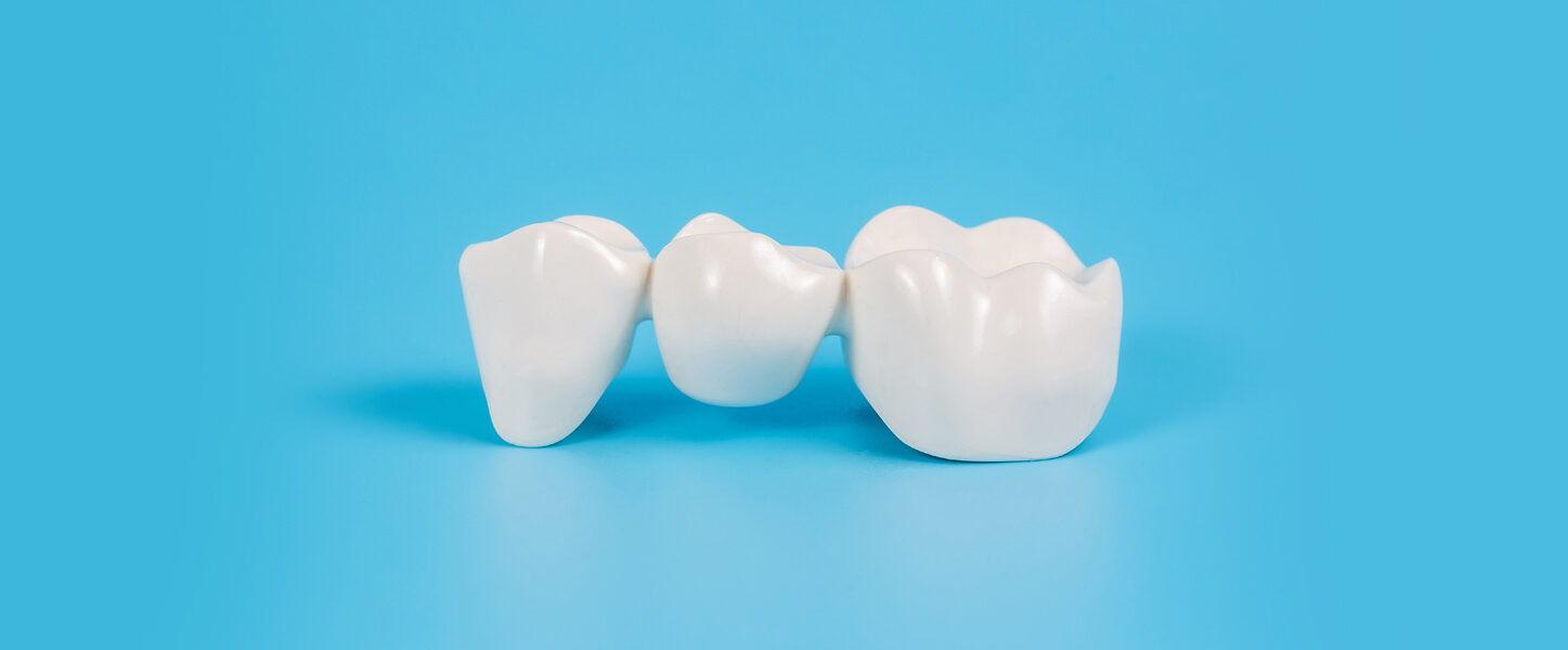 Dental Bridges in Houston TX