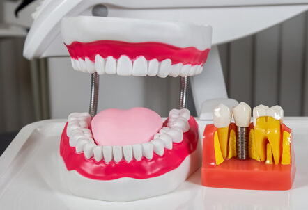 Discovering Dental Implants: What You Need to Know