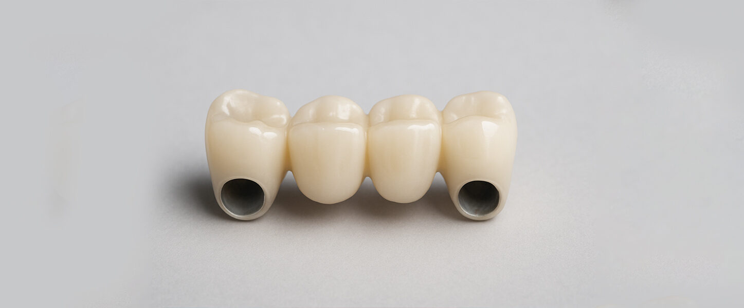 What Happens During a Dental Bridge Procedure?