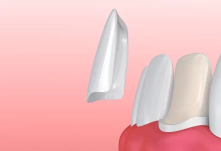 What’s the Recovery Process Like After Getting Porcelain Veneers?