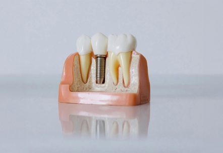 The Ultimate Guide to Dental Implants: Benefits, Procedure, and Care