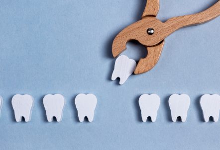 Your 4-Step Guide to Tooth Extraction in Houston, TX